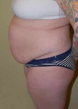 Before Image: Tummy Tuck, Liposuction - other