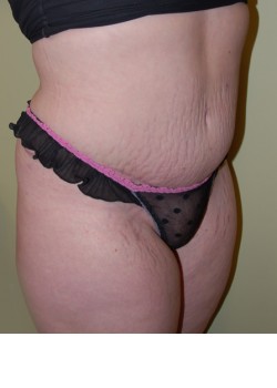 After Image: Tummy Tuck, Liposuction - right-front-oblique