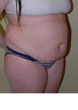 Before Image: Tummy Tuck, Liposuction - right-front-oblique