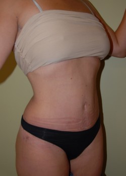 After Image: Tummy Tuck, Liposuction - right-front-oblique