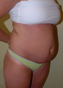 Before Image: Tummy Tuck, Liposuction - right-front-oblique