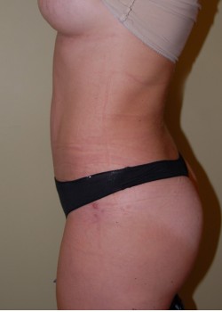 After Image: Tummy Tuck, Liposuction - other