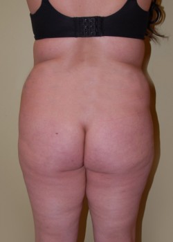 Before Image: Brazilian Butt Lift - front