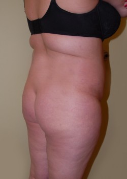 Before Image: Brazilian Butt Lift - right-front-oblique