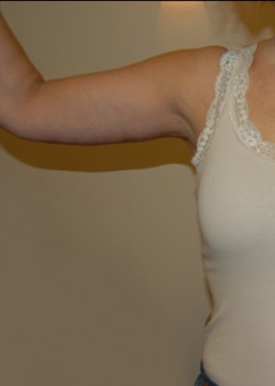 After Image: Arm Lift - front