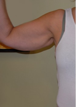 Before Image: Arm Lift - front