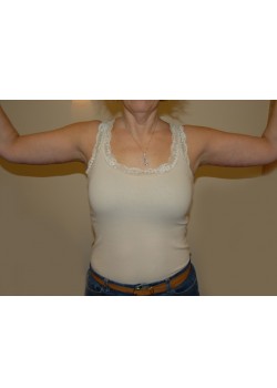 After Image: Arm Lift - front