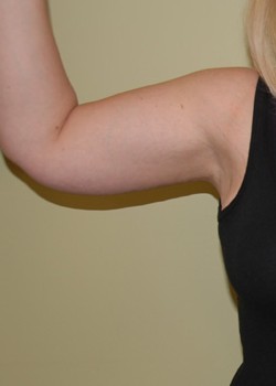 After Image: Arm Lift - front