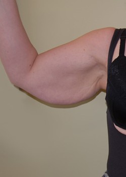 Before Image: Arm Lift - front