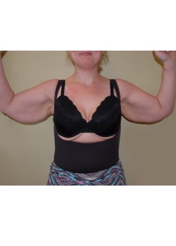 Before Image: Arm Lift - front