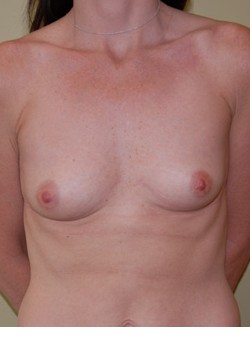 Before Image: Breast Augmentation - front