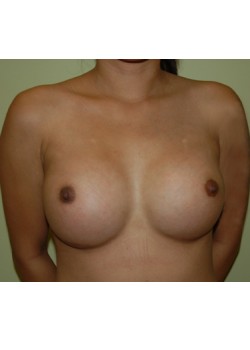 After Image: Breast Augmentation - front