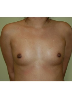 Before Image: Breast Augmentation - front