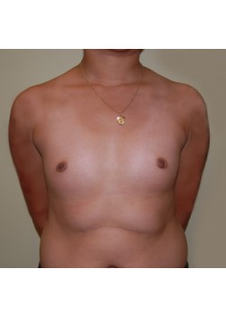 Before Image: Breast Augmentation - front