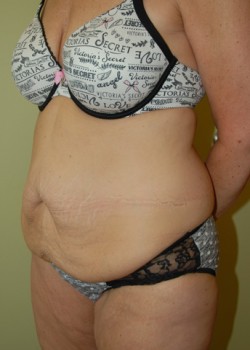 Before Image: Tummy Tuck - left-front-oblique