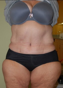 After Image: Tummy Tuck - front