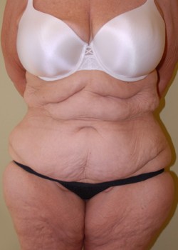 Before Image: Tummy Tuck - front