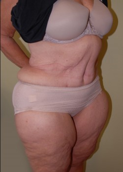 After Image: Tummy Tuck - right-front-oblique