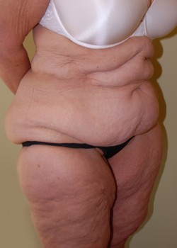 Before Image: Tummy Tuck - right-front-oblique