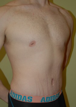 After Image: Tummy Tuck - right-front-oblique