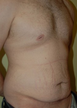 Before Image: Tummy Tuck - right-front-oblique