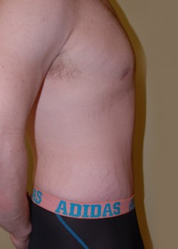 After Image: Tummy Tuck - other