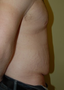 Before Image: Tummy Tuck - other