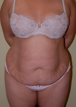Before Image: Tummy Tuck, Liposuction - front