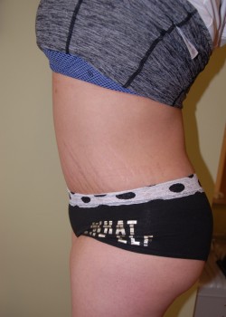 After Image: Tummy Tuck, Liposuction - other