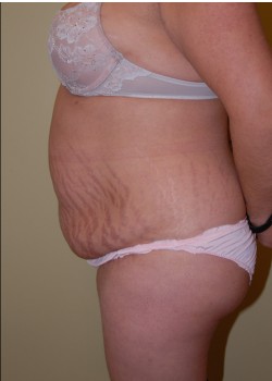 Before Image: Tummy Tuck, Liposuction - other