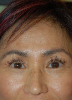 After Image: Asian Double Eyelid - front