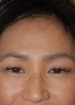 Before Image: Asian Double Eyelid - front