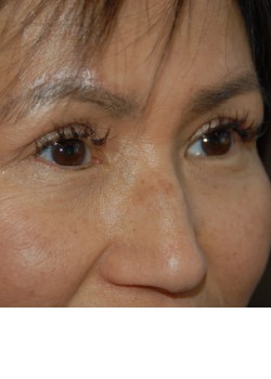 After Image: Asian Double Eyelid - right-front-oblique
