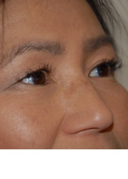 Before Image: Asian Double Eyelid - right-front-oblique