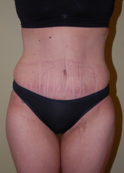 After Image: Tummy Tuck - front