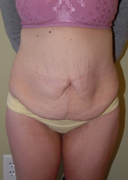 Before Image: Tummy Tuck - front