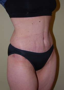 After Image: Tummy Tuck - right-front-oblique