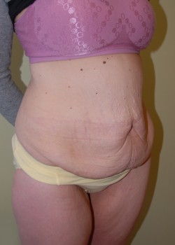 Before Image: Tummy Tuck - right-front-oblique