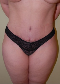 After Image: Tummy Tuck, Liposuction - front