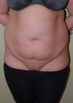 Before Image: Tummy Tuck, Liposuction - front