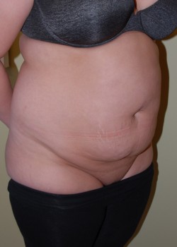 Before Image: Tummy Tuck, Liposuction - right-front-oblique
