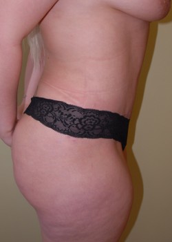 After Image: Tummy Tuck, Liposuction - other