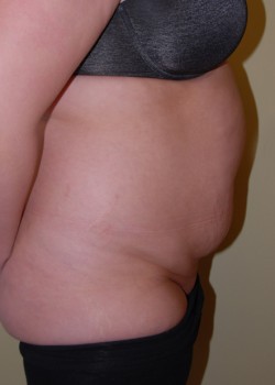 Before Image: Tummy Tuck, Liposuction - other