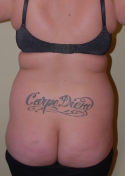 Before Image: Liposuction Back and Love Handles - front