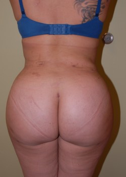 After Image: Brazilian Butt Lift - front