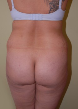 Before Image: Brazilian Butt Lift - front