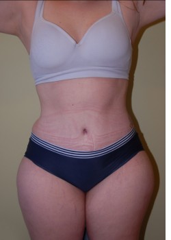 After Image: Tummy Tuck, Liposuction - front