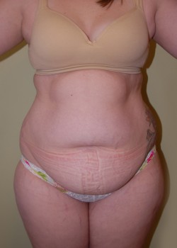 Before Image: Tummy Tuck, Liposuction - front