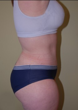 After Image: Tummy Tuck, Liposuction - other
