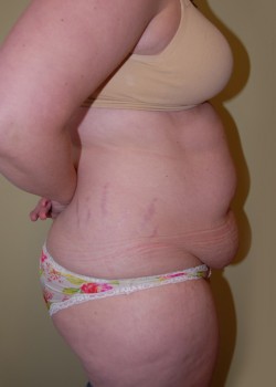 Before Image: Tummy Tuck, Liposuction - other